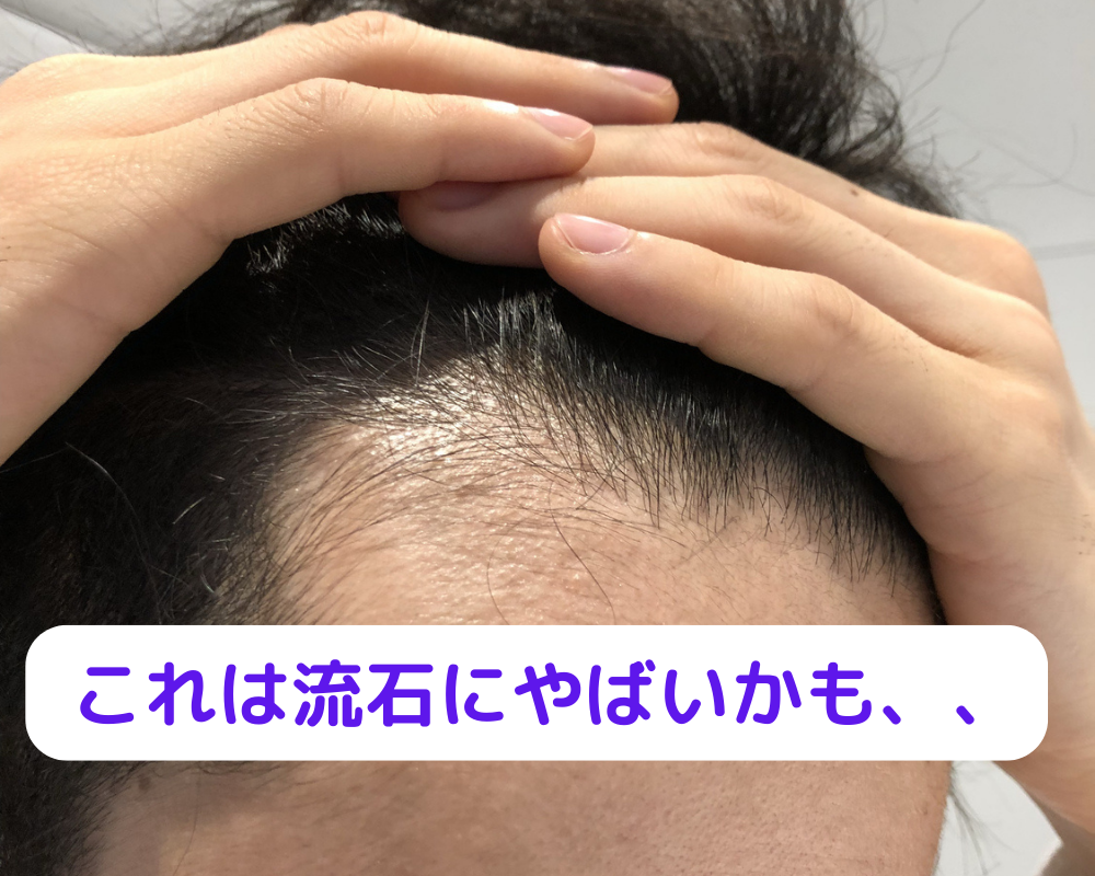 「ハゲは生理的にムリ」